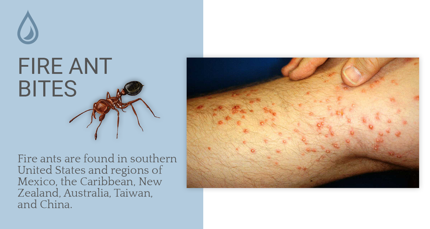 fire ant insect bites