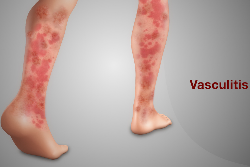 Vasculitis: síntomas, causa y tratamiento