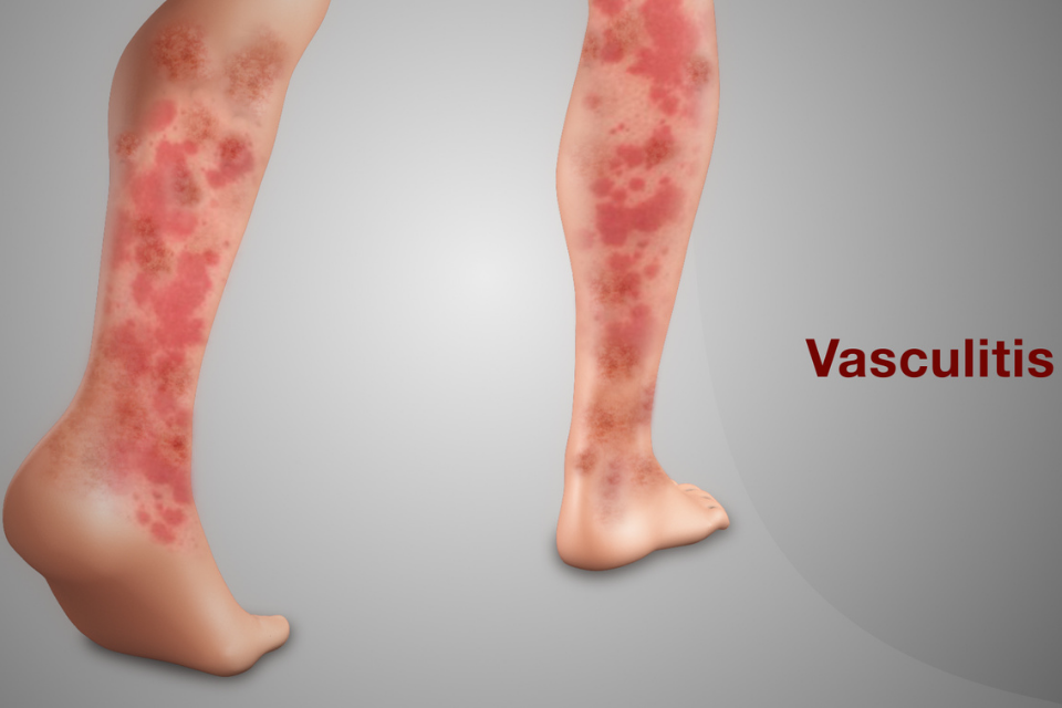 Vasculitis The Dermatology Specialists