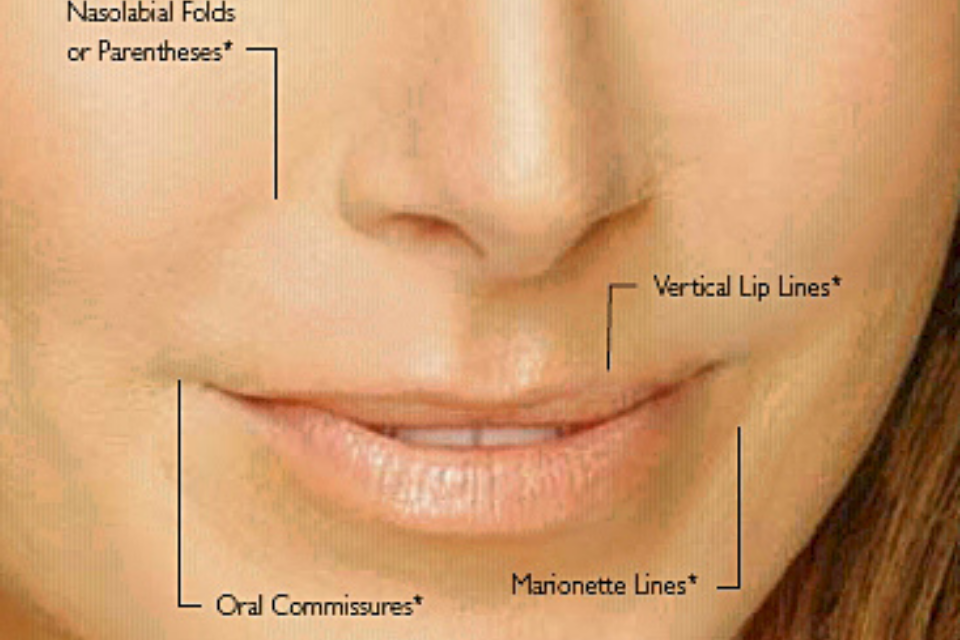 fillers for acne scars