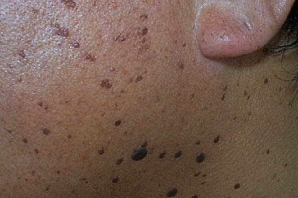 Brown Spots - Mayoral Dermatology