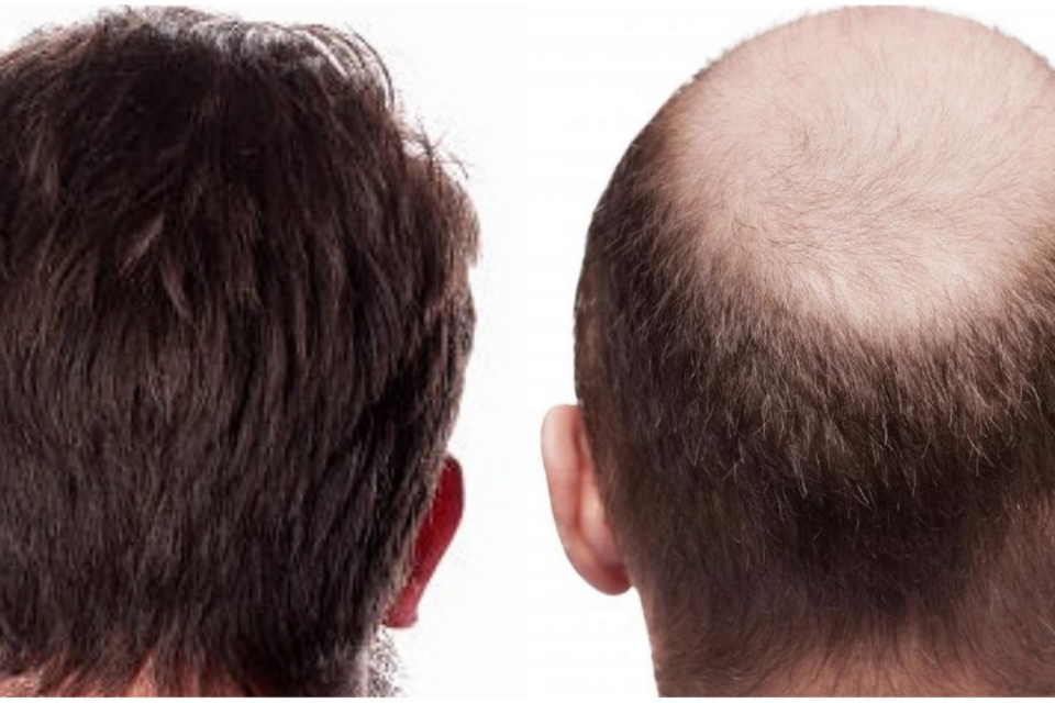 Fractional Resurfacing After Hair Transplant - The Dermatology Specialists