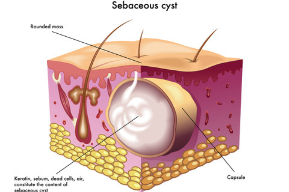 Cyst infected sebaceous Epidermoid Cyst,