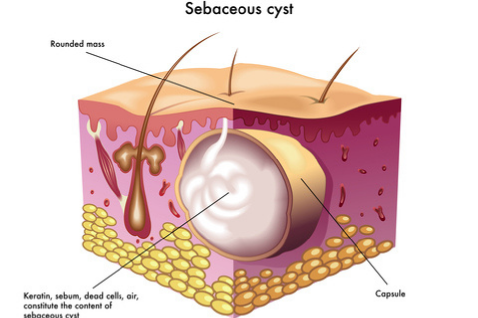 I have a large sebaceous cyst - should I be worried? - The Dermatology  Specialists