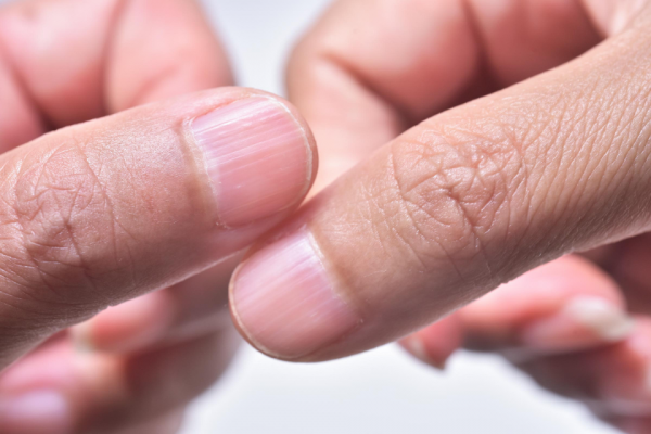horizontal ridges in fingernails