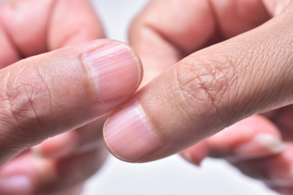 horizontal ridges in nails