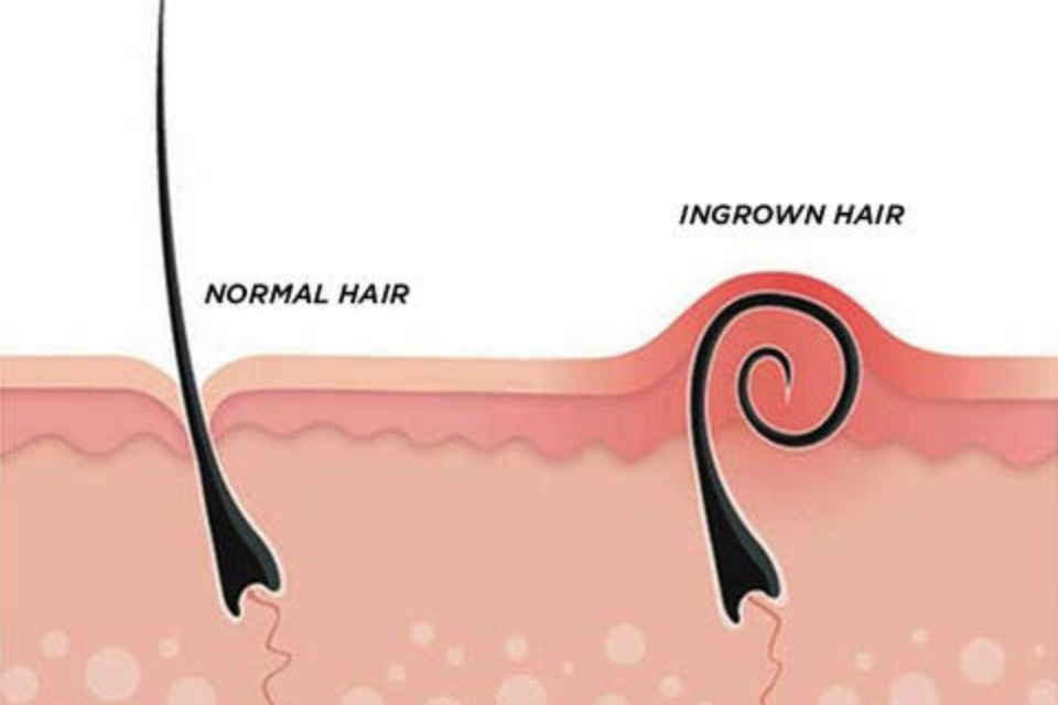Is there any help for treating very stubborn, chronic ingrown hairs? - The  Dermatology Specialists