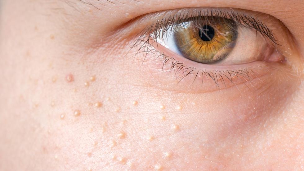 koud violist Rodeo Is the Erbium-YAG laser suitable for syringomas in the eye? - The Dermatology Specialists koud violist Rodeo Is the Erbium-YAG laser suitable for syringomas in the eye? - The Dermatology Specialists