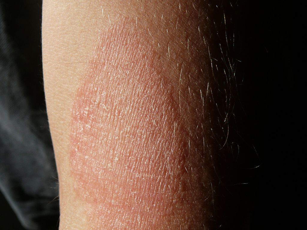 Dr. Bobby Buka Eczema Remedy