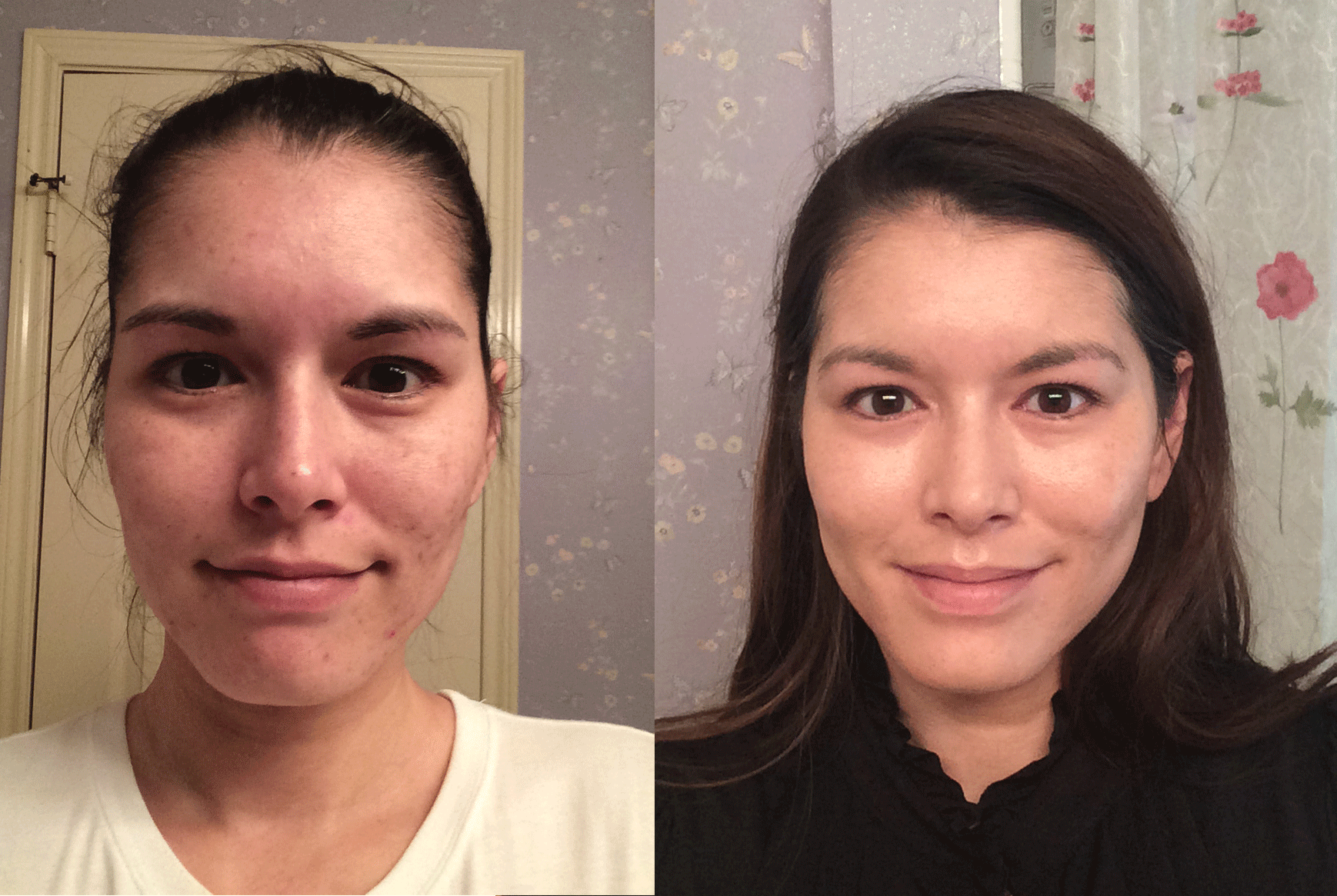 tretinoin before and after.