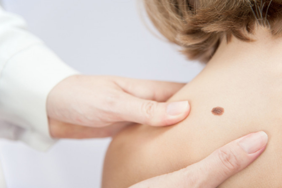 Birthmarks: To Remove or Not to Remove? - The Dermatology Specialists