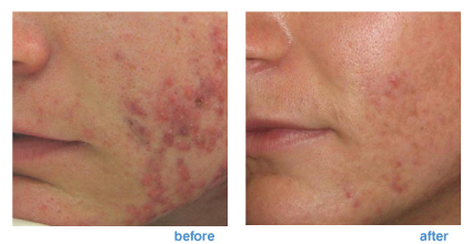 acne scar treatment before and after image
