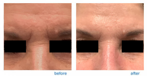 Botox Injection Before and After Dermatology Sepcialists