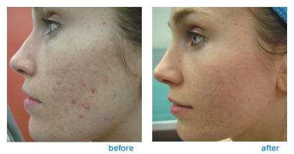 fractional co2 laser for acne scars