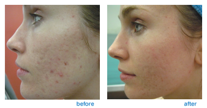 Acne Scars Laser Treatment Before And After