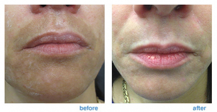 laser skin resurfacing