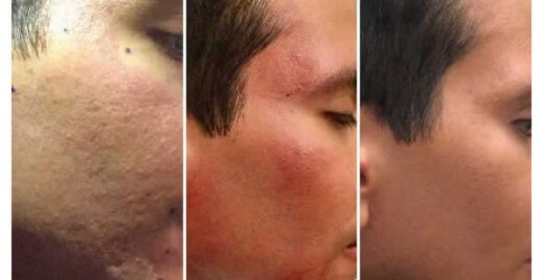 Microneedling before and after