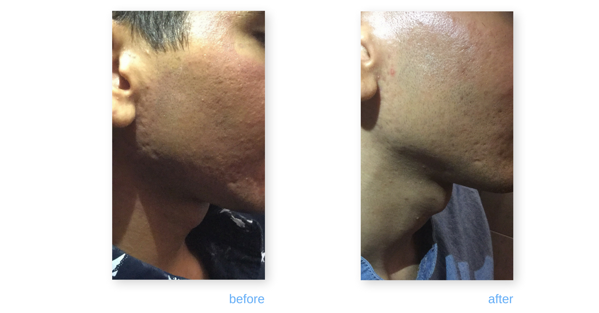 prp skin treatment