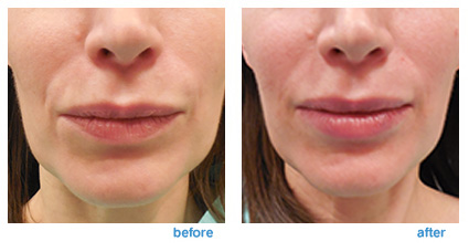 dermal fillers