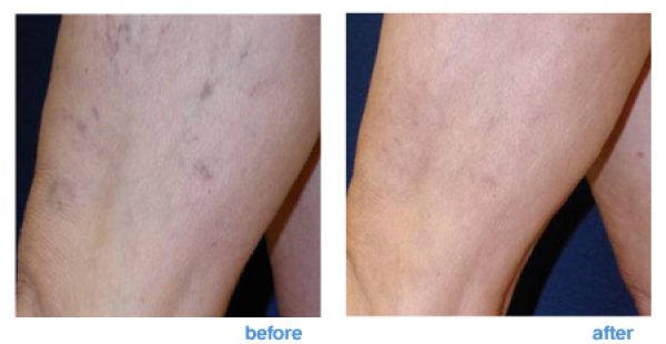 sclerotherapy treatment