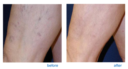 sclerotherapy treatment