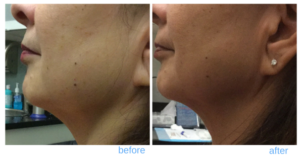 ultherapy neck lift