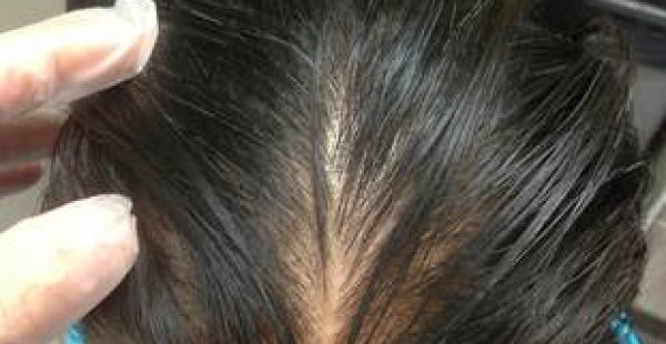 hair loss treatments in new york city