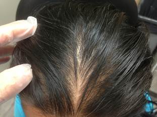 hair loss treatments in new york city