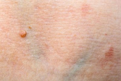 human papillomavirus skin warts)