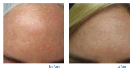 Chemical peels from a dermatologist