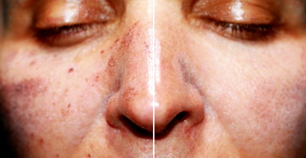 laser treatment before and after