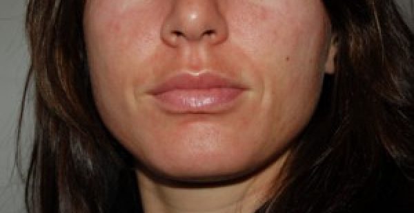 rosacea treatments in new york city