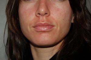 rosacea treatments in new york city