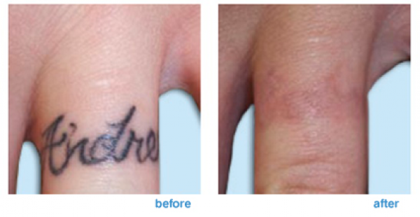 laser tattoo removal