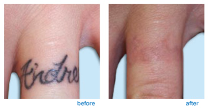 Laser Tattoo Removal - The Dermatology Specialists