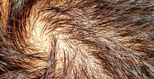 prp therapy for hair