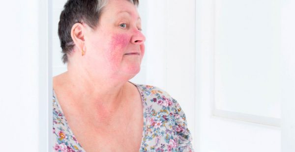 dr-bobby-buka-rosacea