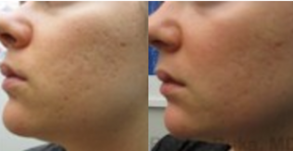 ablative laser resurfacing