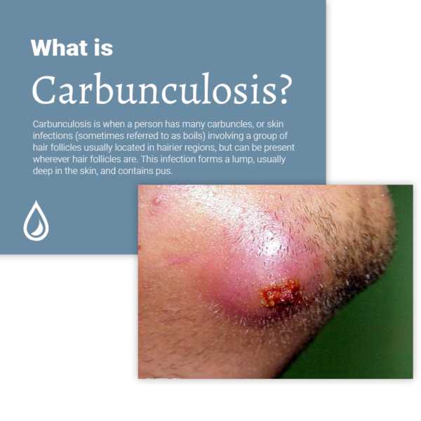 Carbunculose Causas e Opções de Tratamento Eficazes Localizador