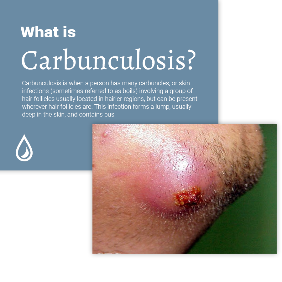 carbunculosis