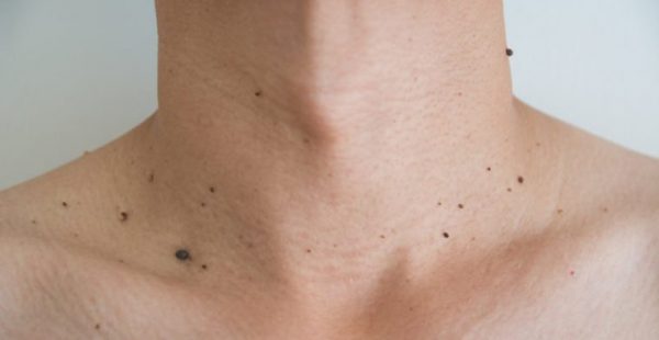 moles on neck