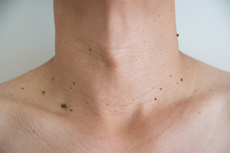 moles on neck