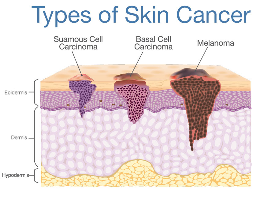 types of skin cancer illustration