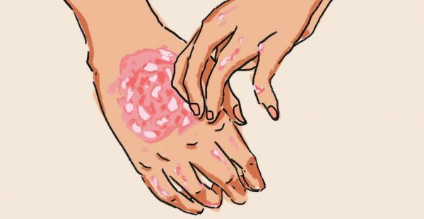 illustration of hand rash