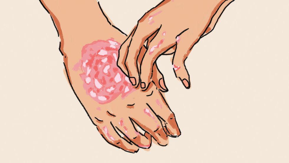 illustration of hand rash