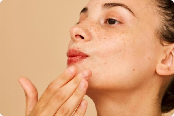 Image of acne on chin and jawline