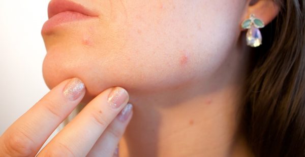 women with acne on chin