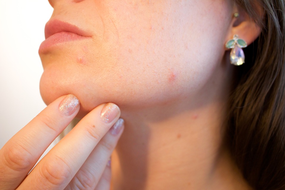 women with acne on chin