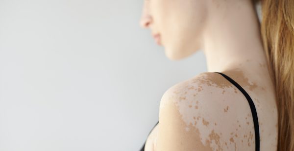 vitiligo spots on women's shoulder