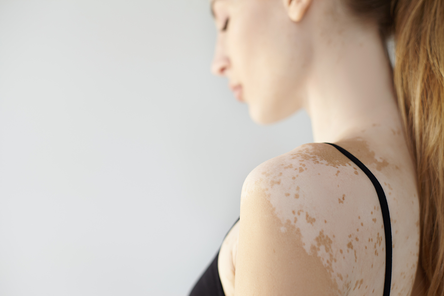 vitiligo spots on women's shoulder